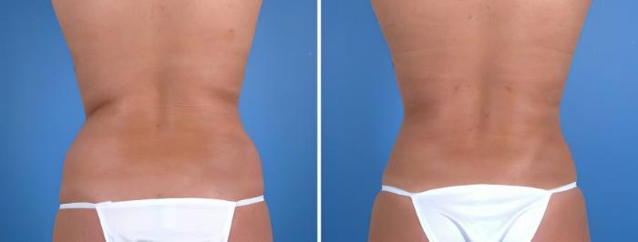 Liposuction Before & After Case 18040