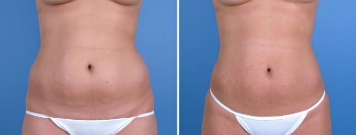 Liposuction Before & After Case 18040