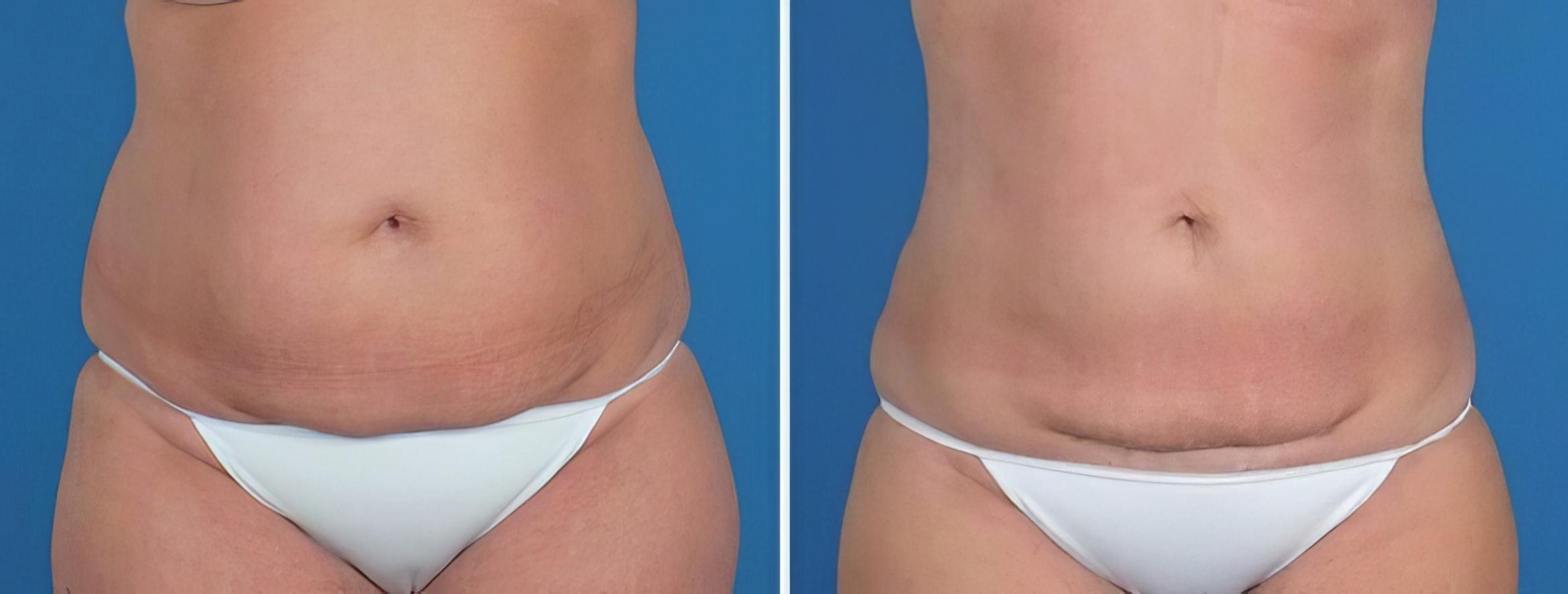 Liposuction Before & After Case 22930