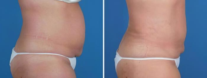 Liposuction Before & After Case 22930
