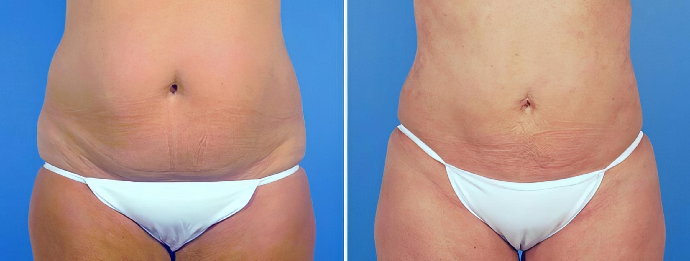 Liposuction Before & After Case 25228