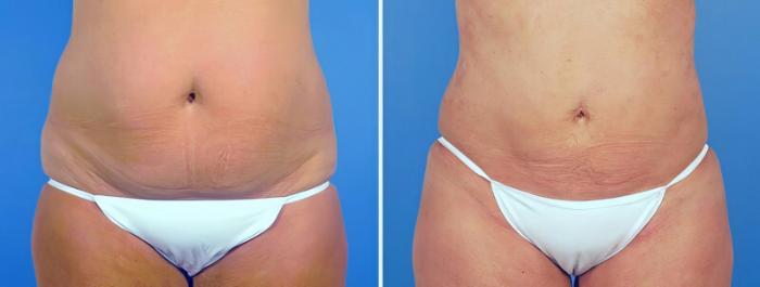 Liposuction Before & After Case 25228