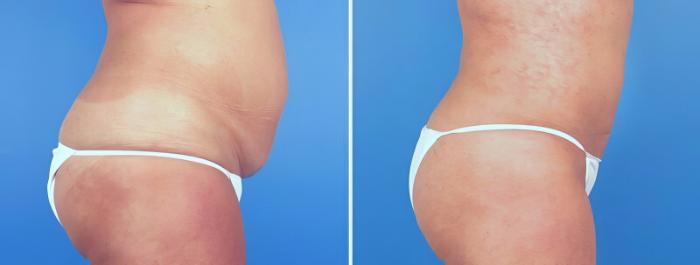 Liposuction Before & After Case 25228