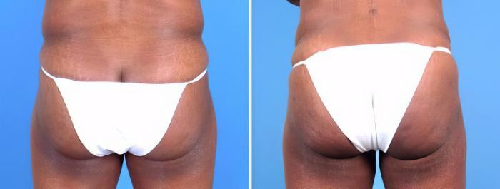 Liposuction Before & After Case 25657