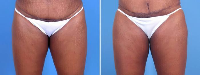 Liposuction Before & After Case 25657