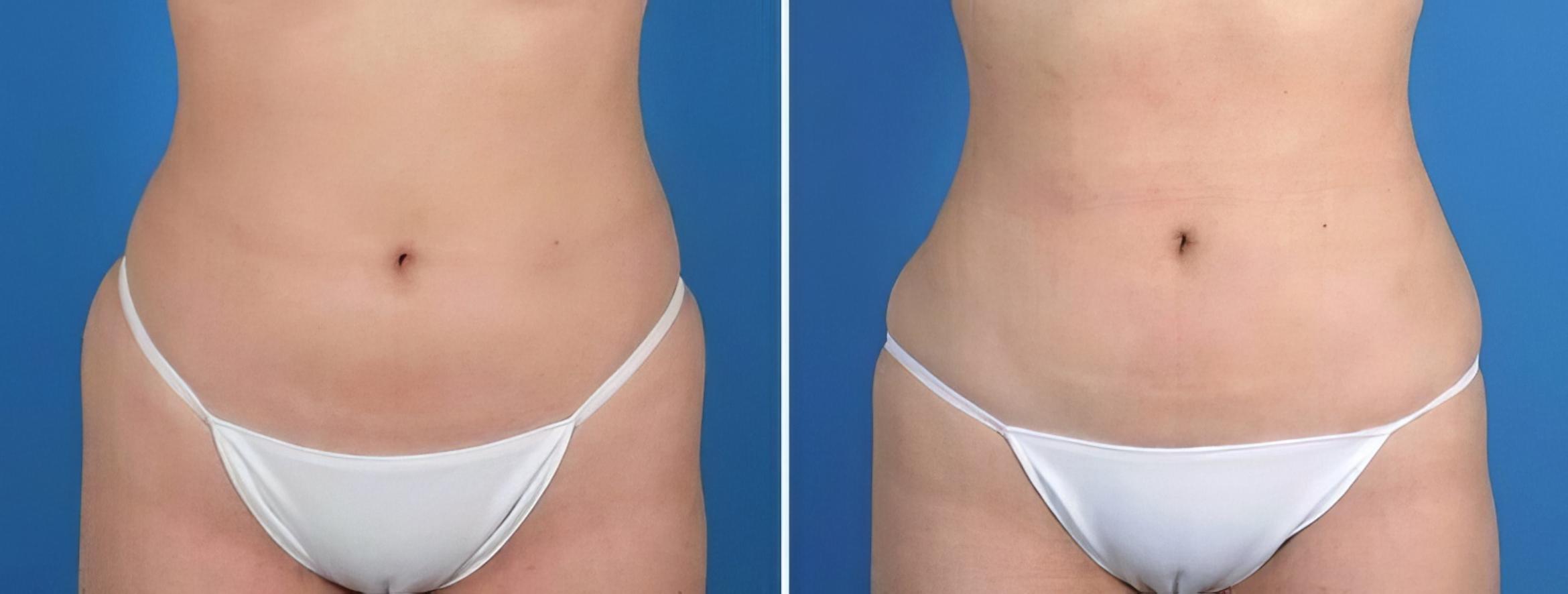Liposuction Before & After Case 25665