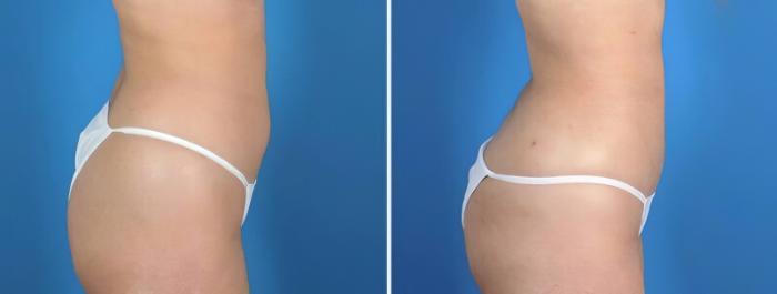 Liposuction Before & After Case 25665