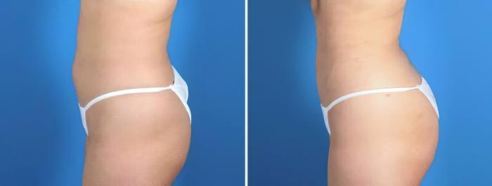 Liposuction Before & After Case 25665