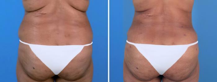Liposuction Before & After Case 25670