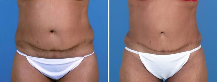 Liposuction Before & After Case 25670