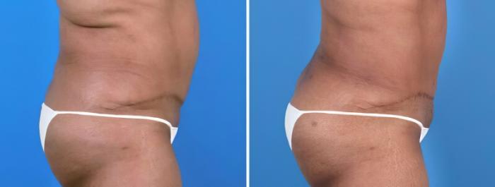 Liposuction Before & After Case 25670