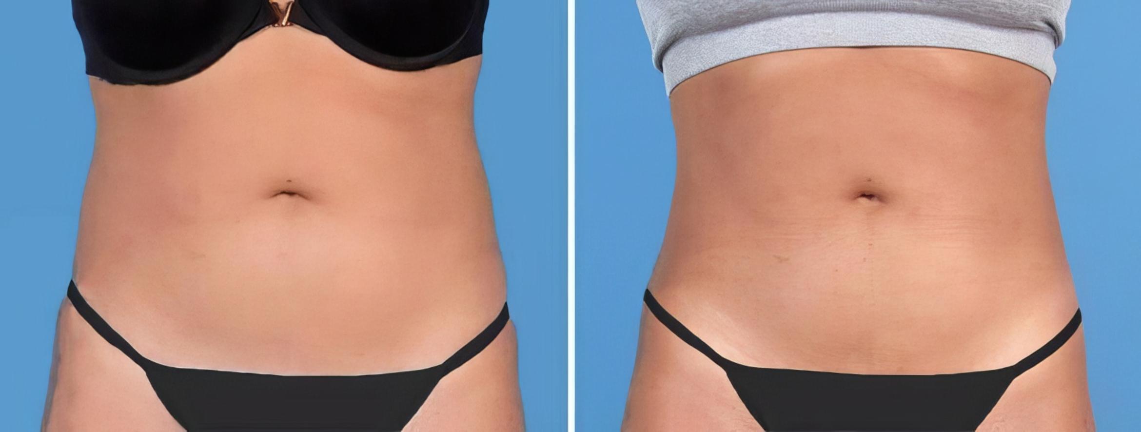 Liposuction Before & After Case 25769