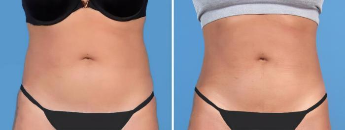 Liposuction Before & After Case 25769