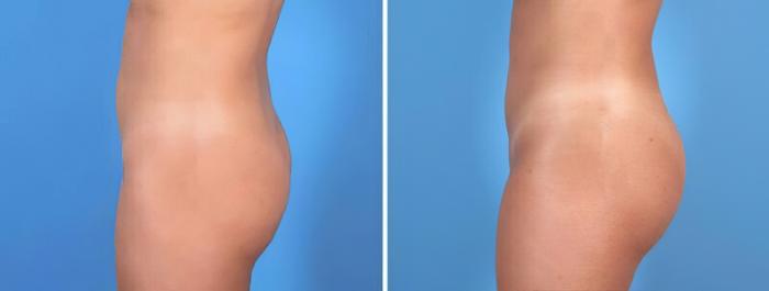 Liposuction Before & After Case 25769