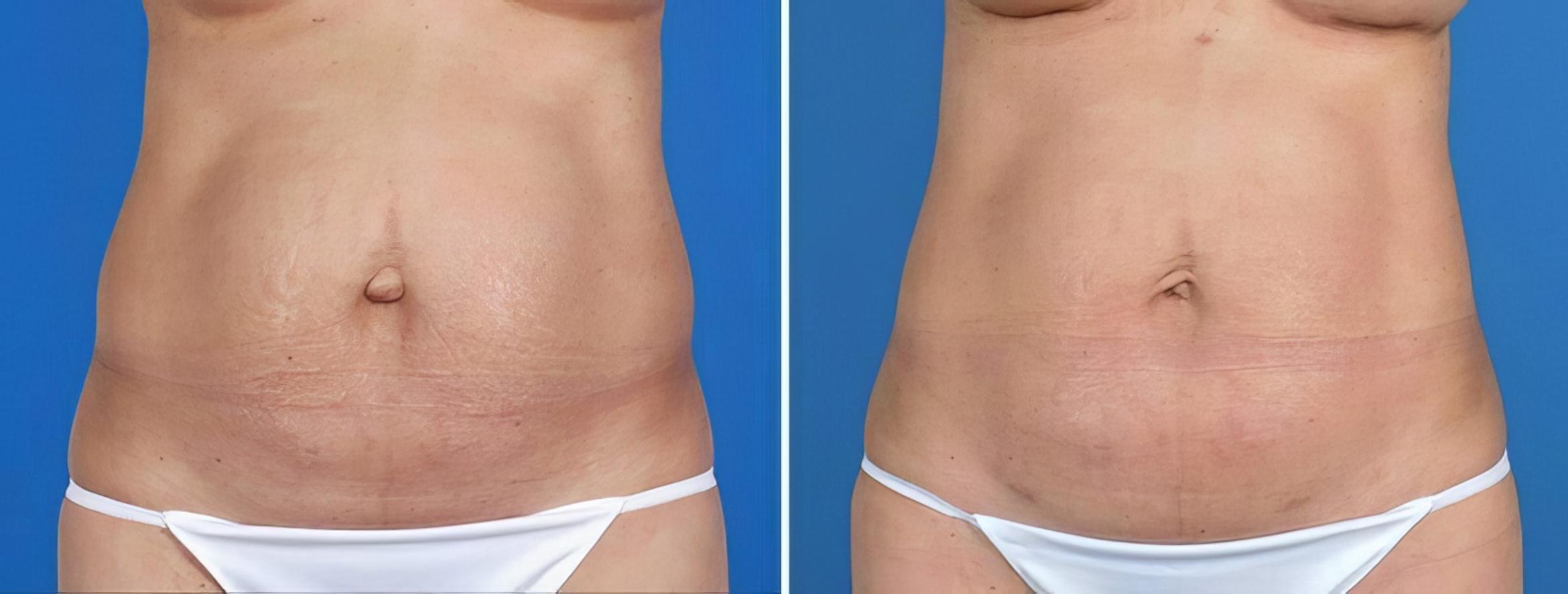 Liposuction Before & After Case 25814