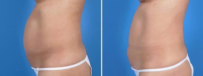 Liposuction Before & After Case 25814