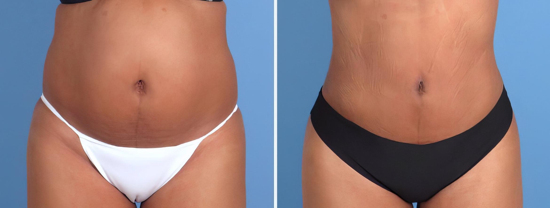 Liposuction Before & After Case 26701