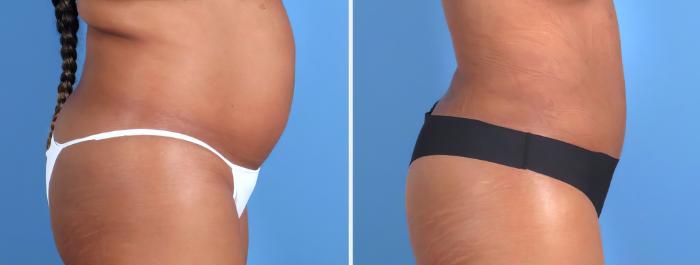 Liposuction Before & After Case 26701
