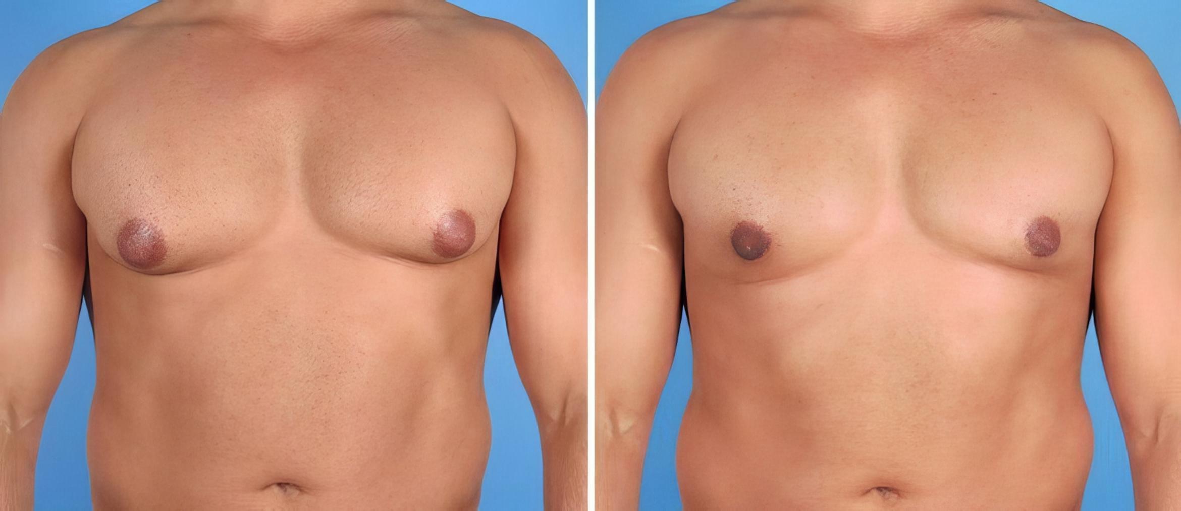 Male Breast Reduction Before & After Case 17355