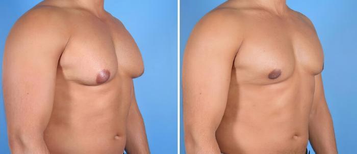 Male Breast Reduction Before & After Case 17355