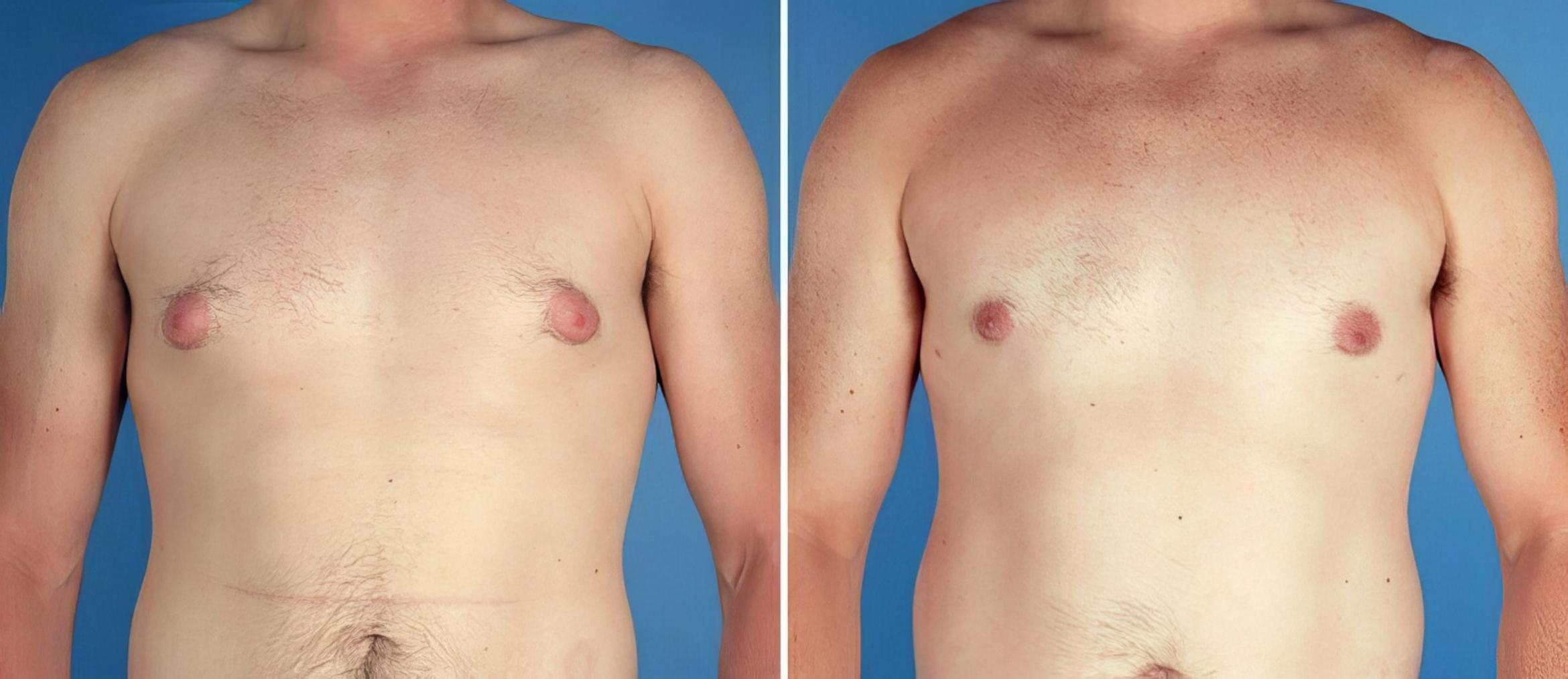 Male Breast Reduction Before & After Case 17370