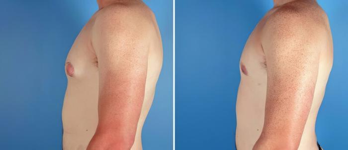 Male Breast Reduction Before & After Case 17370