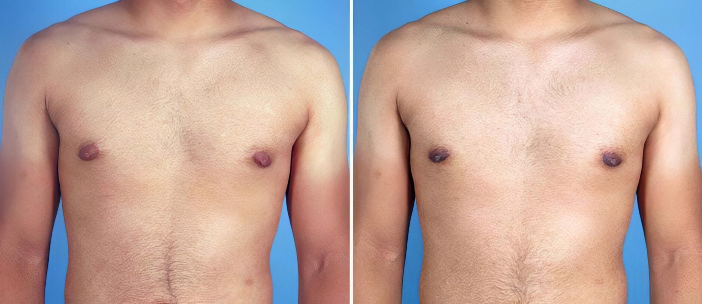 Male Breast Reduction Before & After Case 19535