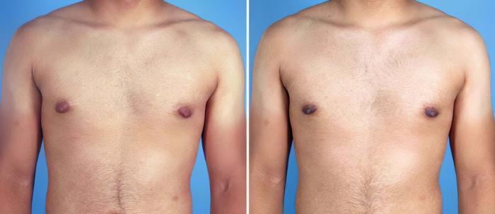 Male Breast Reduction Before & After Case 19535