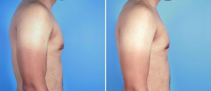 Male Breast Reduction Before & After Case 19535
