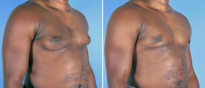 Male Breast Reduction Before & After Case 19538