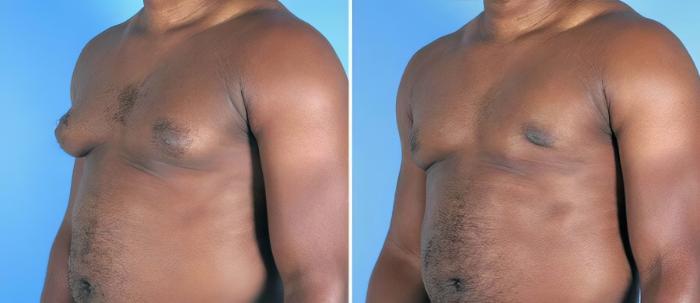Male Breast Reduction Before & After Case 19538
