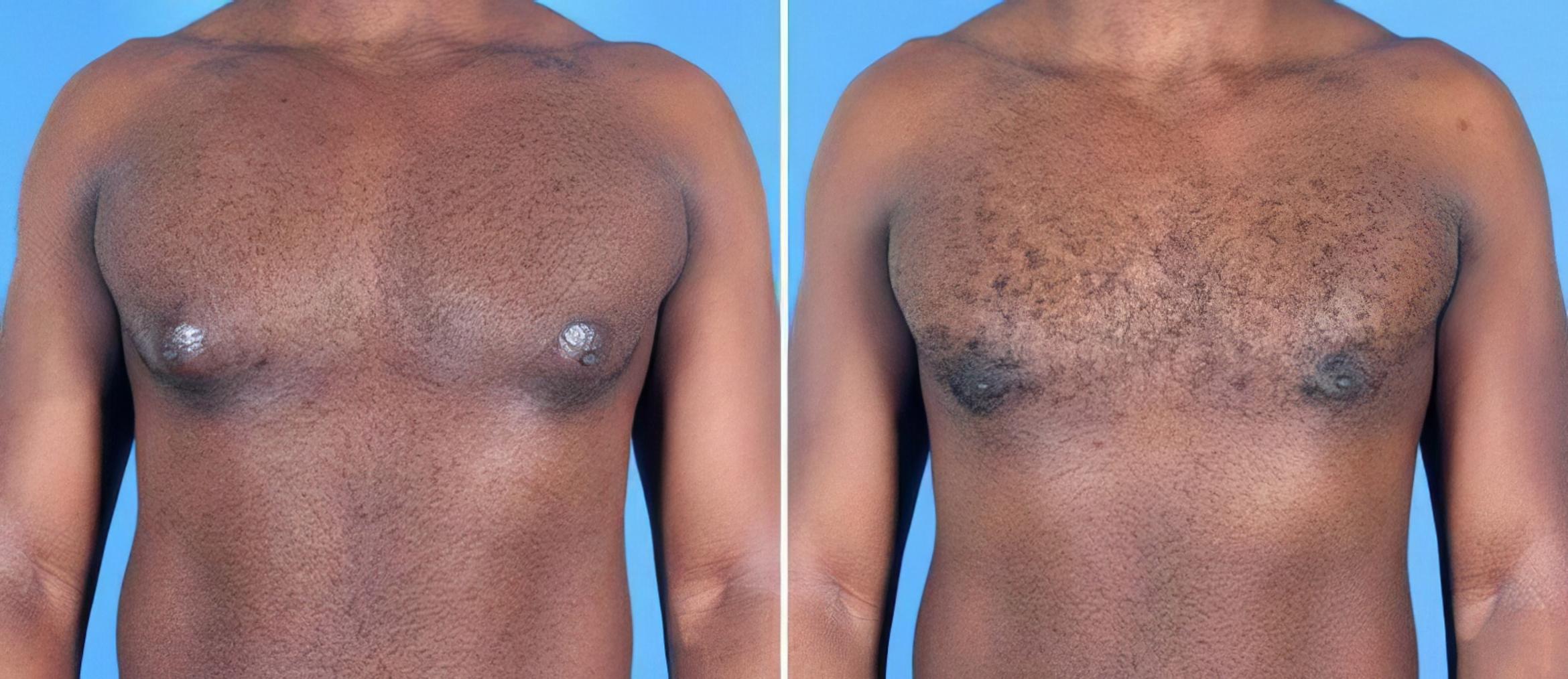 Male Breast Reduction Before & After Case 25627