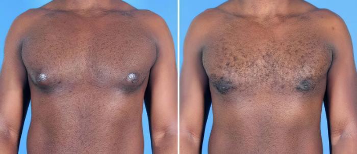 Male Breast Reduction Before & After Case 25627