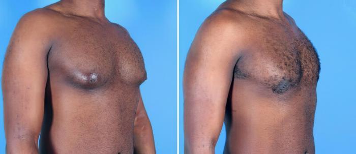 Male Breast Reduction Before & After Case 25627