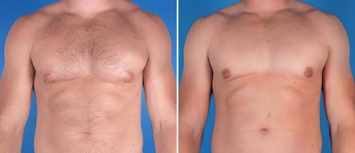 Male Breast Reduction Before & After Case 25631
