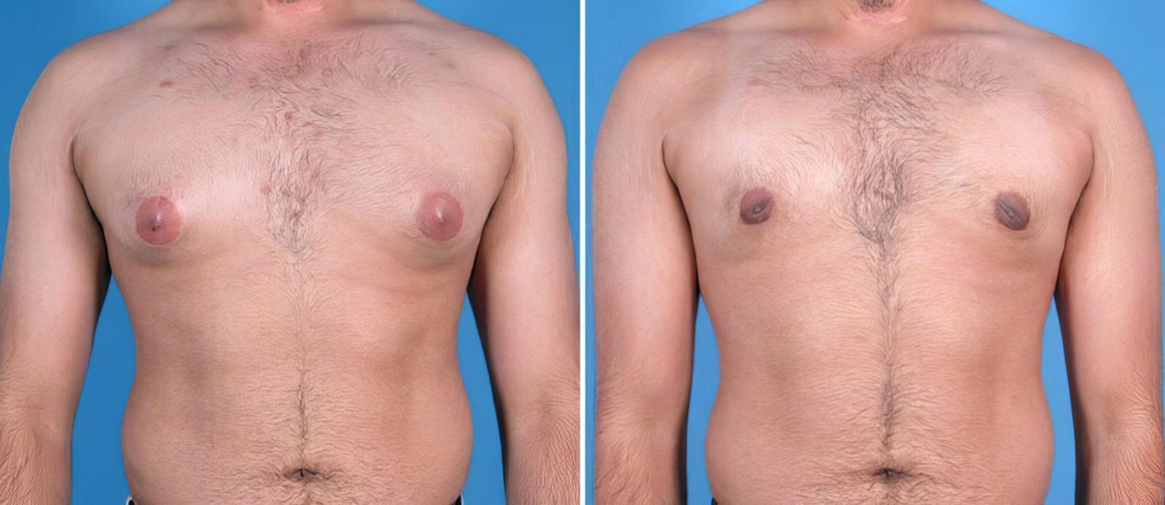 Male Breast Reduction Before & After Case 25633