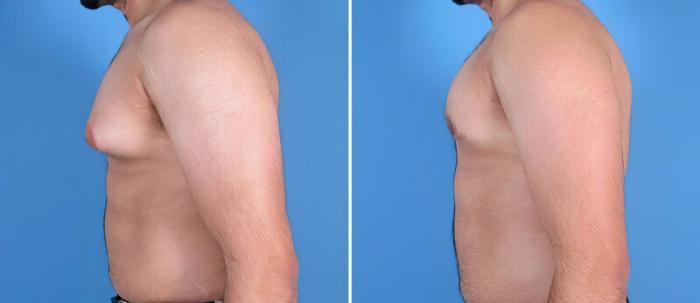 Male Breast Reduction Before & After Case 25633