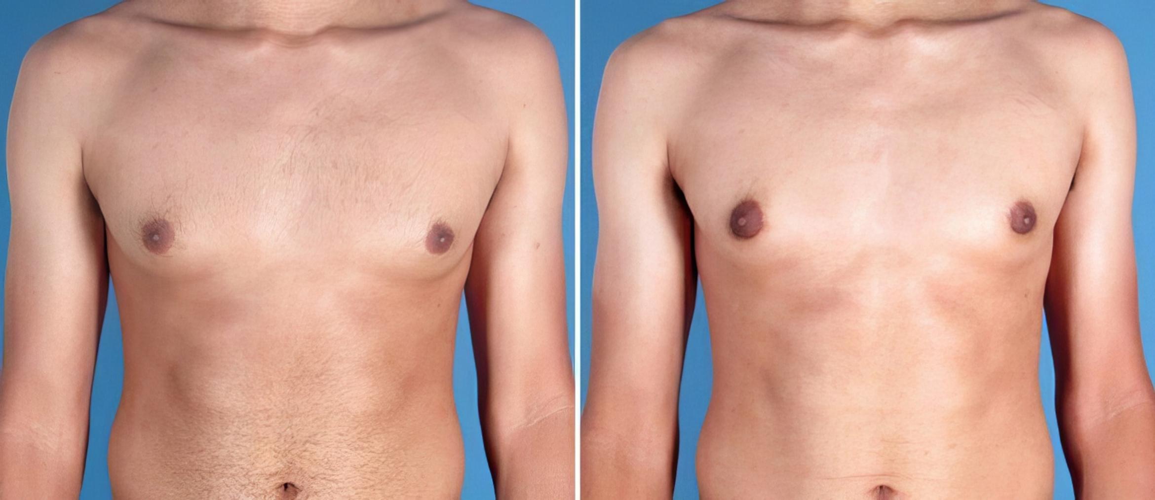 Male Breast Reduction Before & After Case 25636
