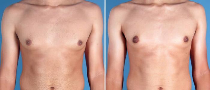 Male Breast Reduction Before & After Case 25636