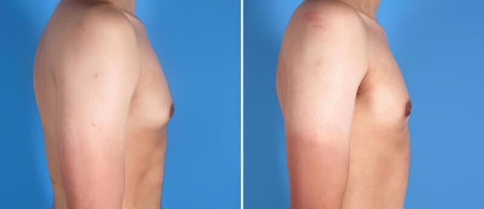 Male Breast Reduction Before & After Case 25636