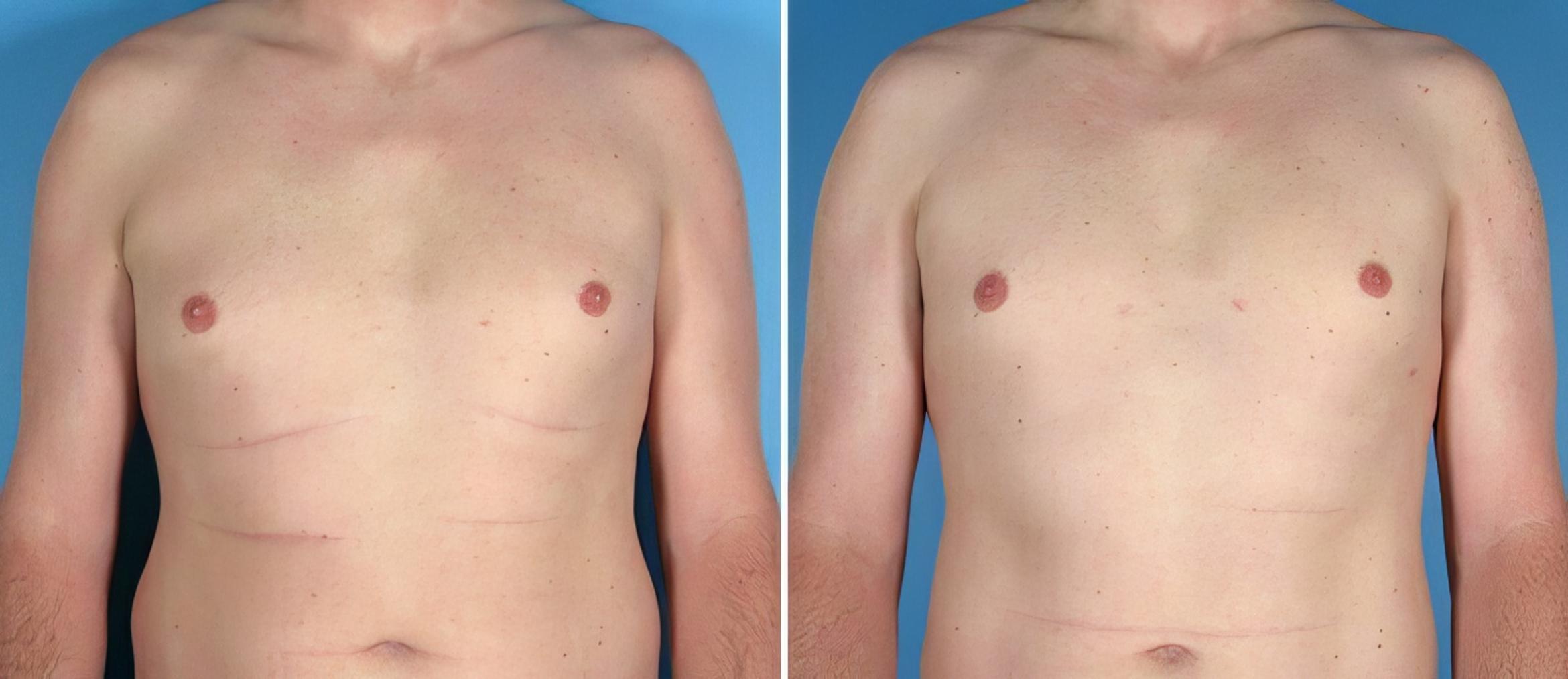 Male Breast Reduction Before & After Case 25776