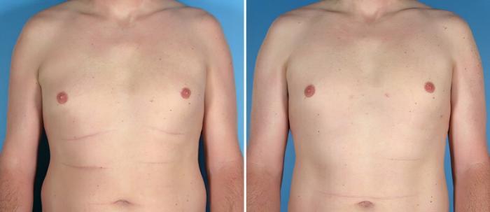 Male Breast Reduction Before & After Case 25776