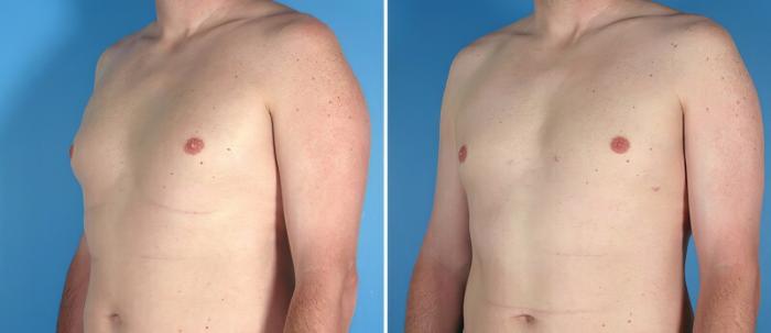 Male Breast Reduction Before & After Case 25776