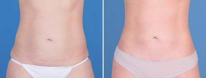 Mini Tummy Tuck Before & After Case 25170