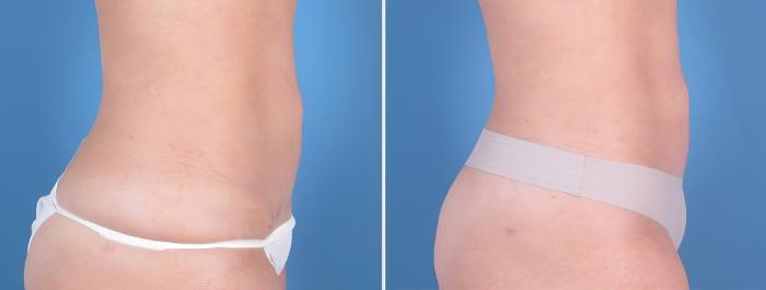 Mini Tummy Tuck Before & After Case 25170
