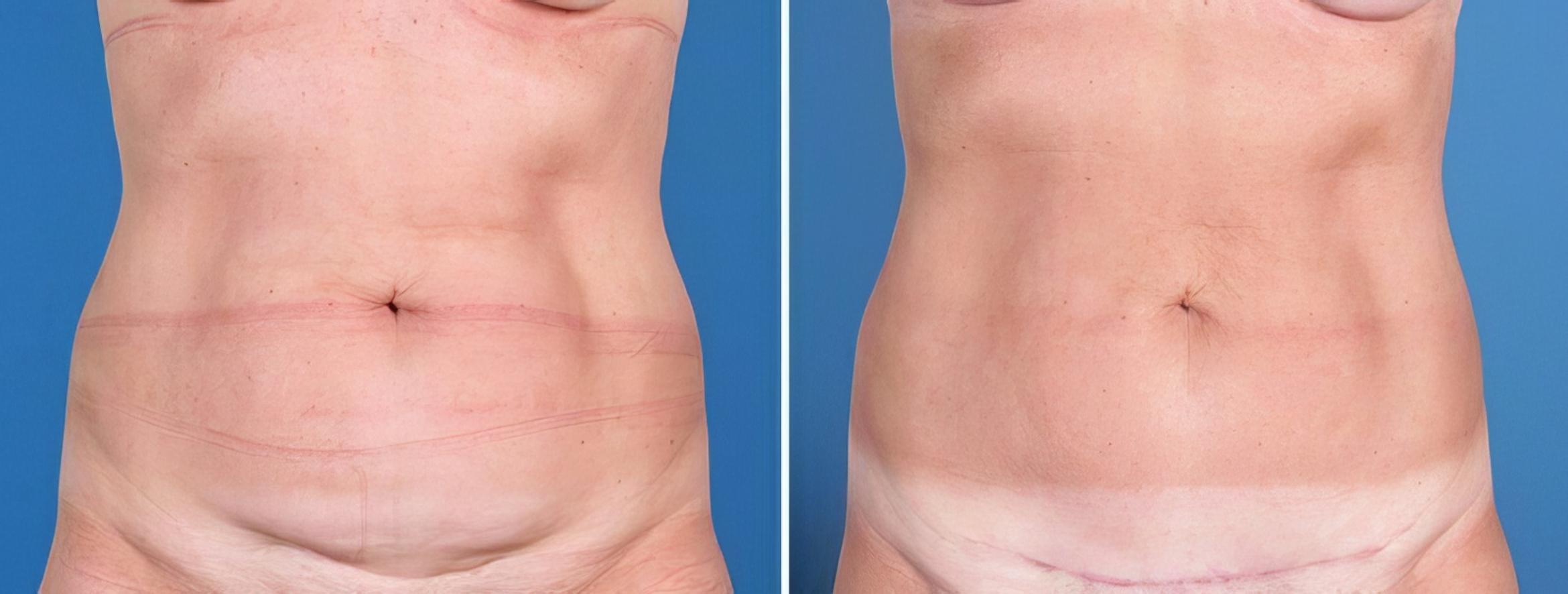 Mini Tummy Tuck Before & After Case 25642
