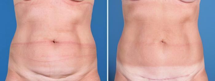 Mini Tummy Tuck Before & After Case 25642