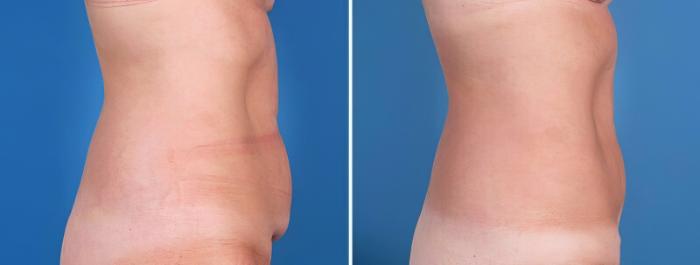 Mini Tummy Tuck Before & After Case 25642