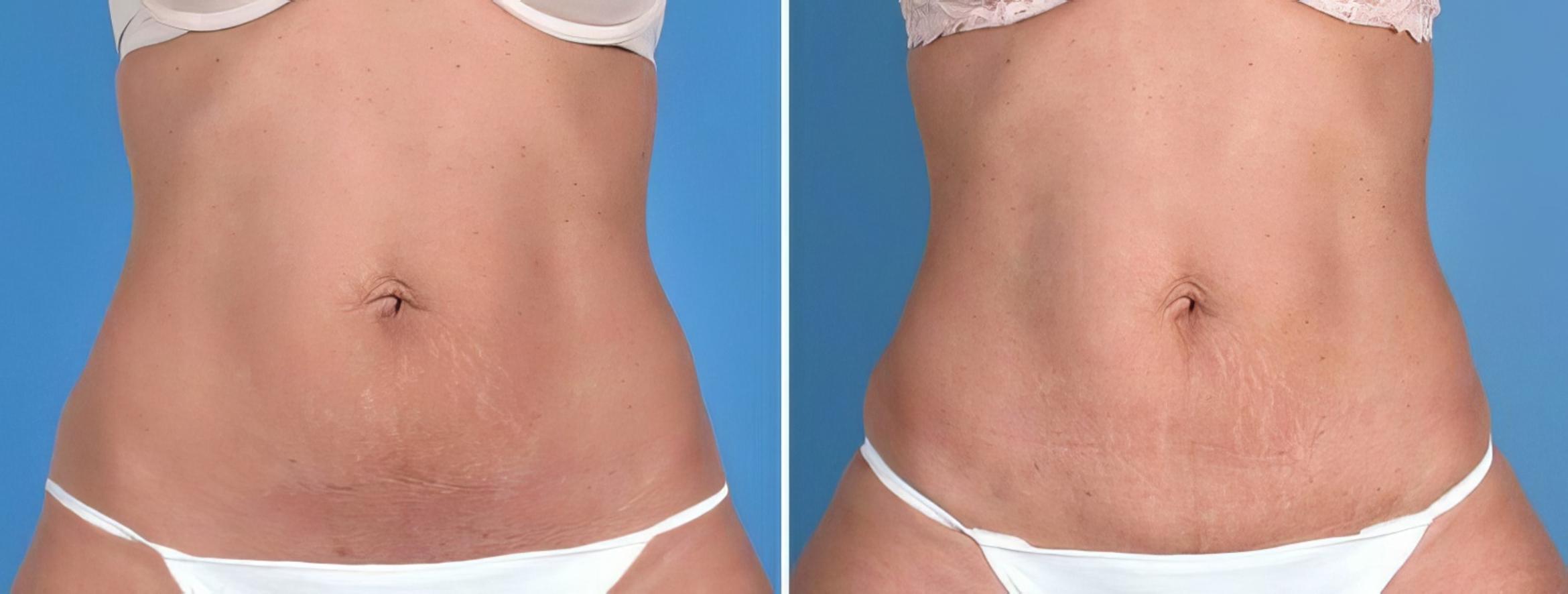 Mini Tummy Tuck Before & After Case 25674