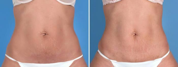 Mini Tummy Tuck Before & After Case 25674